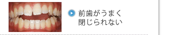 前歯がうまく閉じられない